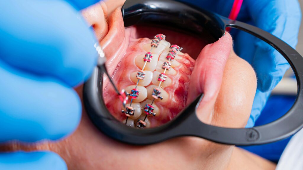 braces treatment